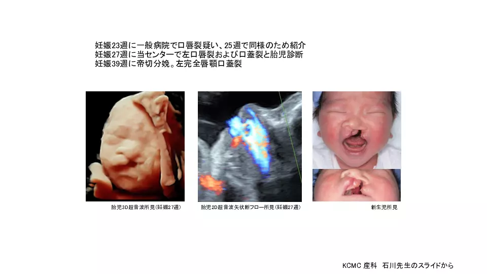 産科医・小児科医に知ってほしい！ 胎児診断から始まる口唇口蓋裂の